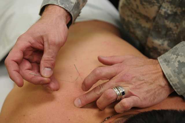 All About Acupuncture