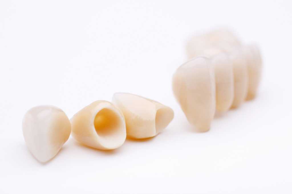 set of dental veneers