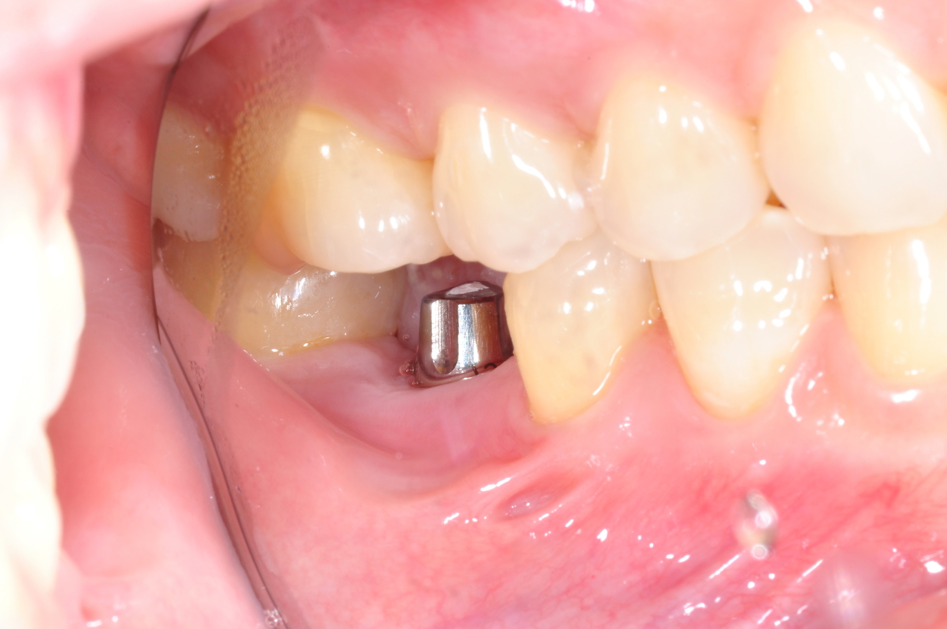 Dental Implant firmly intact