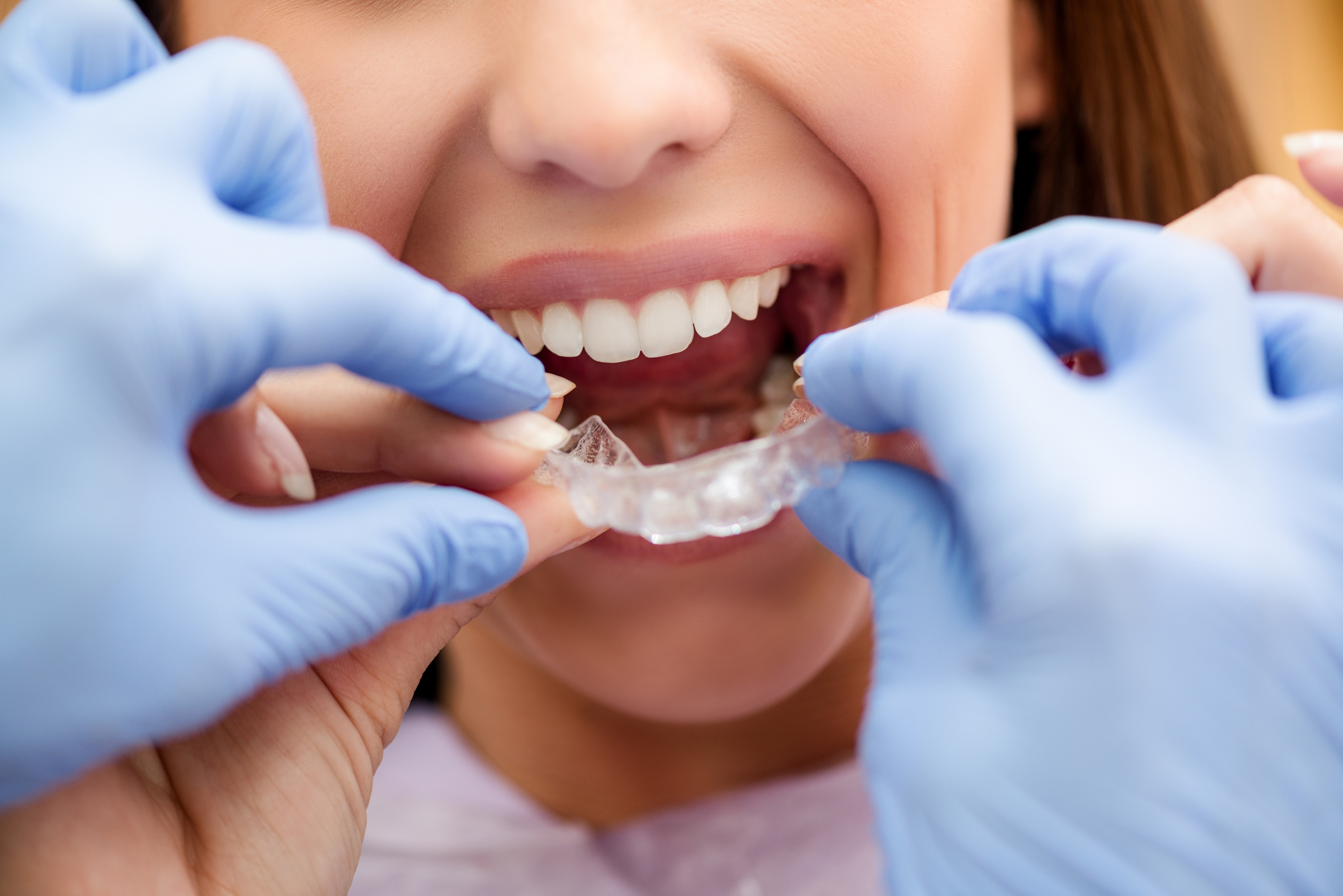 Dentist putting on clear braces for patient
