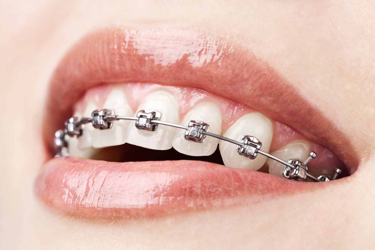 Girl With Braces