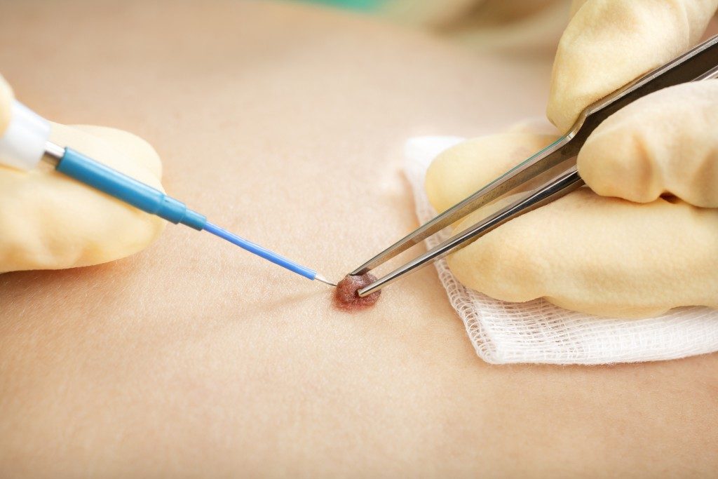 cyst on the skin being removed