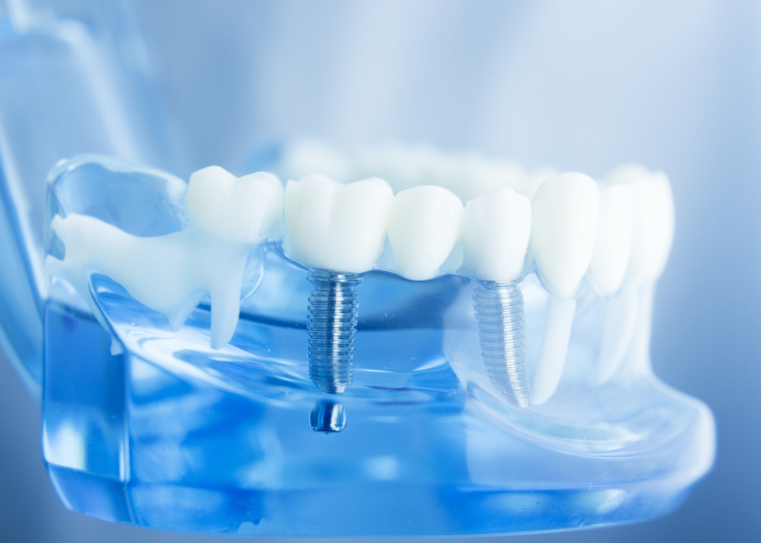 Dental implant sample