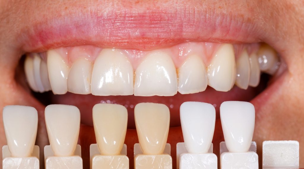 set of dental implants