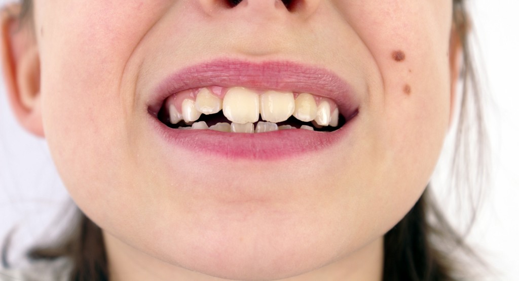 Causes of Crooked Teeth
