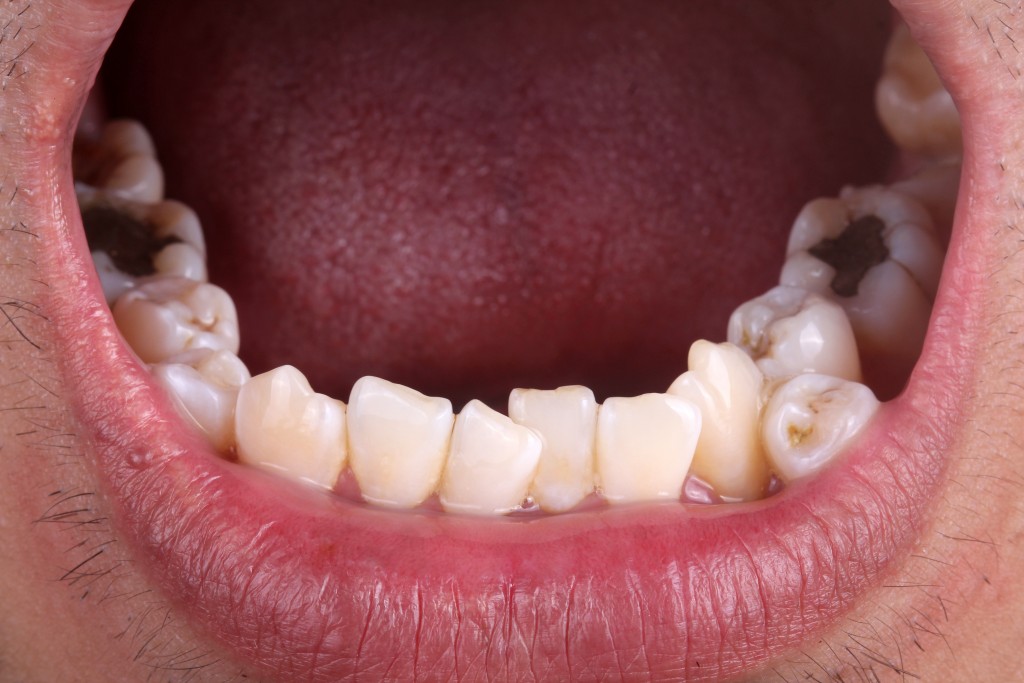 Teeth Care and Preventing Plaque