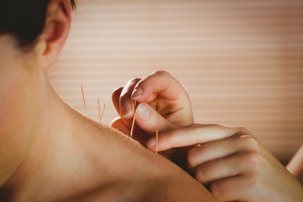 person getting acupuncture