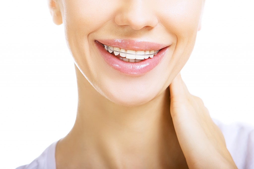 Smiling woman wearing retainers